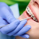 【2022年特集】矯正歯科で行われている治療方法